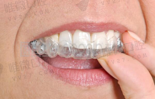 隐形义齿是胶托的吗（前牙胶托义齿）(图1)